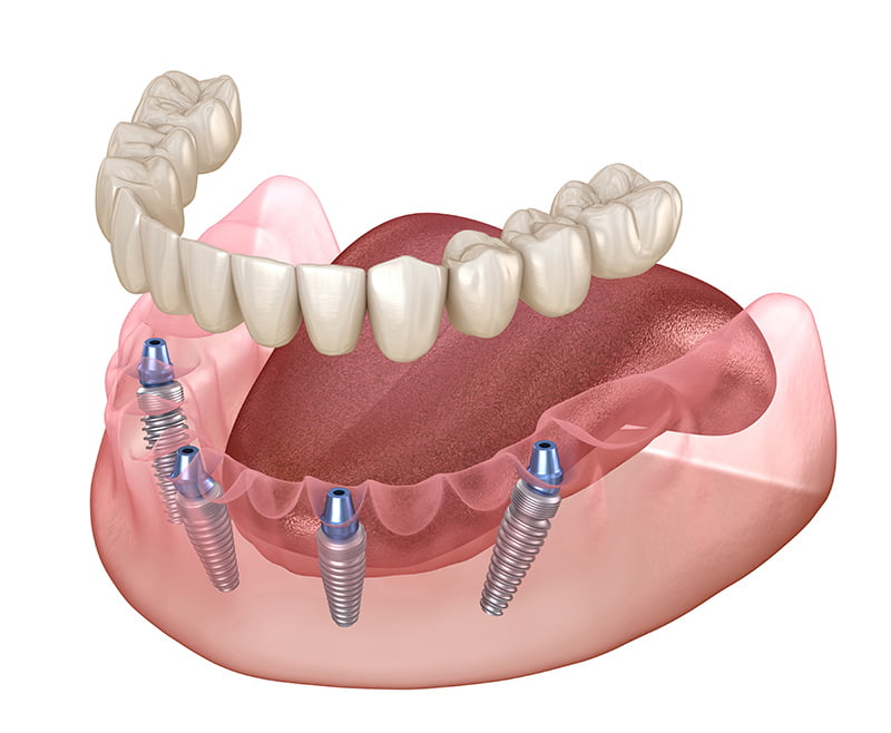 Dentures VS Implants in florida