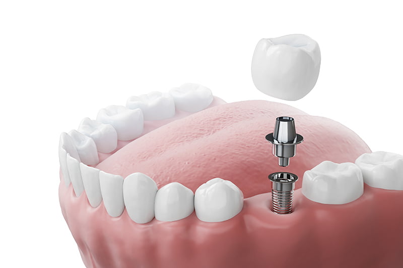 Dental Implants VS Dentures