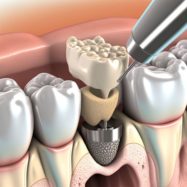 Bone Grafting close to me