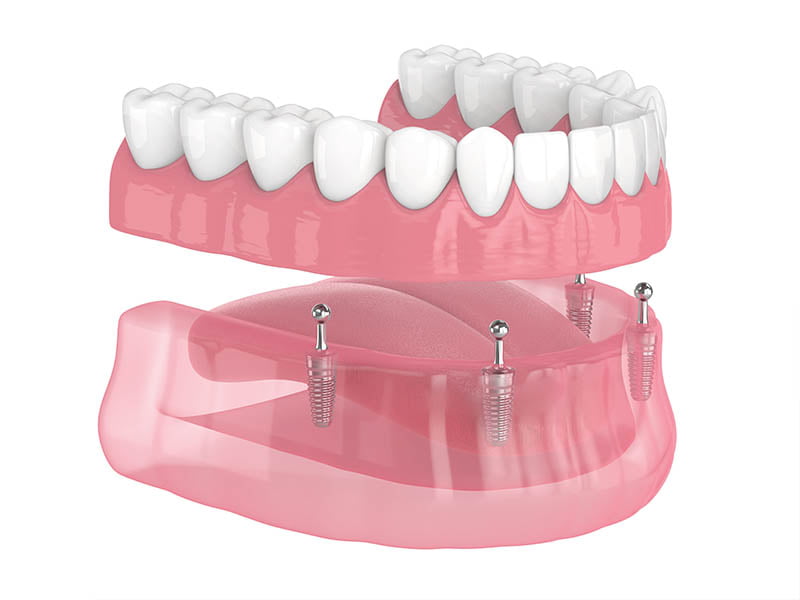 Dental Implant types