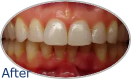 Smile-Gallery_Invisalign-Gallery_Charlotte-S-After-Invisalign_FINAL_Edited_Text.png