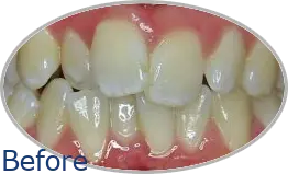Smile-Gallery_Invisalign-Gallery_Invisalign-5-Before_FINAL_Edited_Text.png