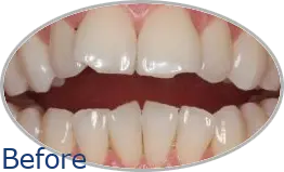 Smile-Gallery_Invisalign-Gallery_Invisalign-6-Before_FINAL_Edited_Text.png