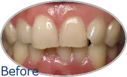 Smile-Gallery_Invisalign-Gallery_Kervin-D-Before-Invisalign_FINAL_Edited_Text-1.png