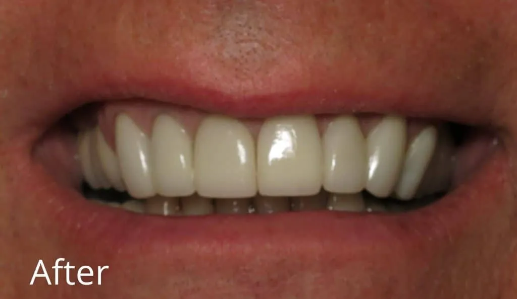 crown dental