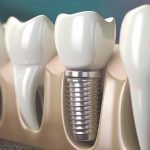 Dental Implants single Northwood Dental